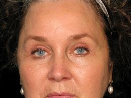 blepharoplasty-austin-tx