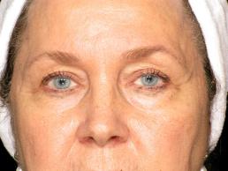 blepharoplasty-austin-tx