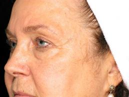 blepharoplasty-austin-tx