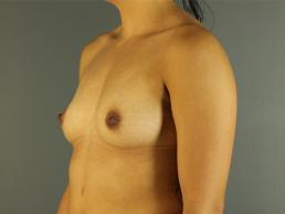 breast-augmentation-austin-tx breast-augmentation-austin-tx