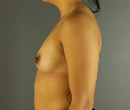 breast-augmentation-austin-tx breast-augmentation-austin-tx