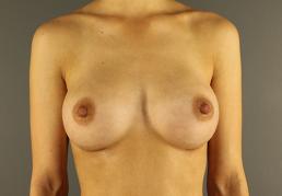 breast-augmentation-austin-tx breast-augmentation-austin-tx
