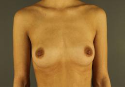 breast-augmentation-austin-tx breast-augmentation-austin-tx