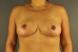 breast-lift-austin-tx