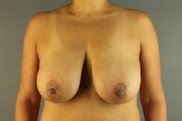 breast-lift-austin-tx