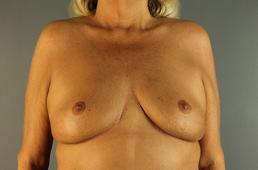 breast-lift-austin-tx