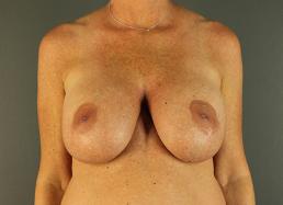 breast-revision-austin-tx