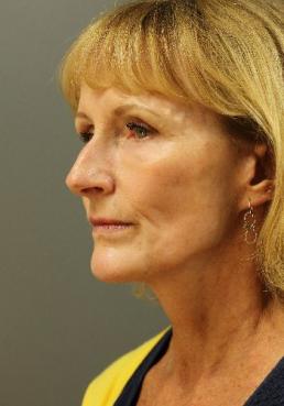 facial-rejuvenation-austin-tx