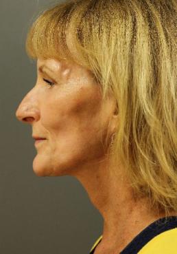 facial-rejuvenation-austin-tx