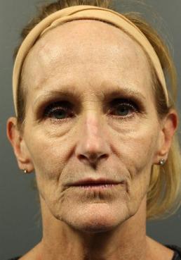 facial-rejuvenation-austin-tx