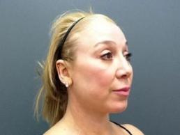 facial-rejuvenation-austin-tx