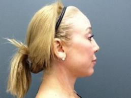 facial-rejuvenation-austin-tx