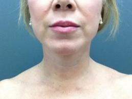 facial-rejuvenation-austin-tx