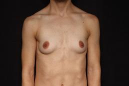 female-to-male-top-surgery-austin-tx