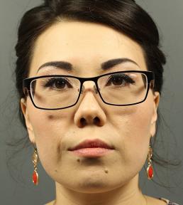 fillers-and-toxins-austin-tx