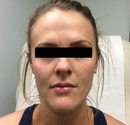 fillers-and-toxins-austin-tx