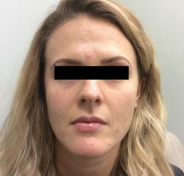 fillers-and-toxins-austin-tx