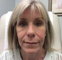 fillers-and-toxins-austin-tx