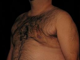 gynecomastia-austin-tx