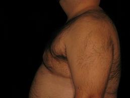 gynecomastia-austin-tx