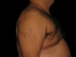 gynecomastia-austin-tx