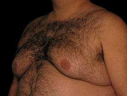 gynecomastia-austin-tx