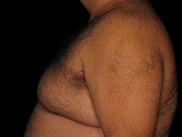 gynecomastia-austin-tx