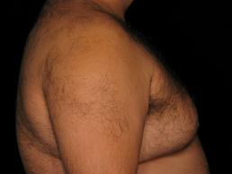 gynecomastia-austin-tx