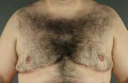 gynecomastia-austin-tx
