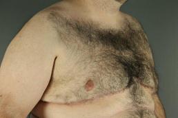 gynecomastia-austin-tx