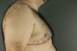 gynecomastia-austin-tx