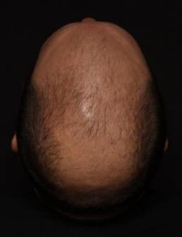 hair-restoration-austin-tx