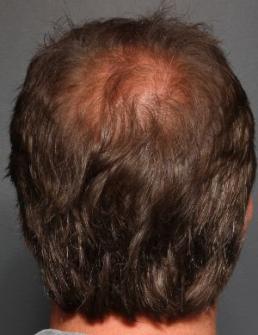 hair-restoration-austin-tx
