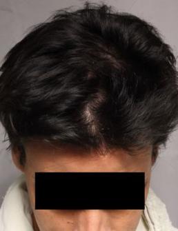 hair-restoration-austin-tx