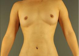 hi-def-vaser-liposuction-austin-tx