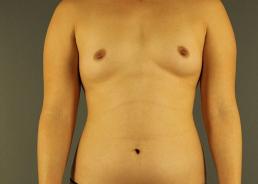 hi-def-vaser-liposuction-austin-tx