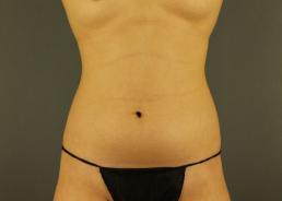 hi-def-vaser-liposuction-austin-tx