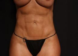 hi-def-vaser-liposuction-austin-tx