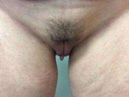 labiaplasty-austin-tx