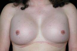 male-to-female-top-surgery-austin-tx