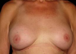 male-to-female-top-surgery-austin-tx