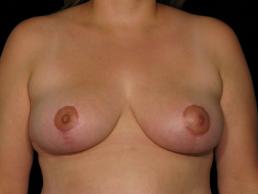 breast-lift-austin-tx