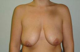 breast-lift-austin-tx