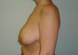 breast-lift-austin-tx