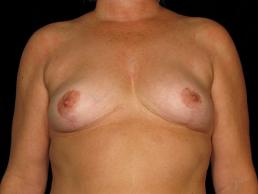 breast-lift-austin-tx