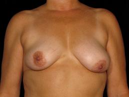 breast-lift-austin-tx