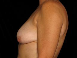 breast-lift-austin-tx