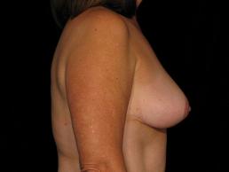 breast-lift-austin-tx