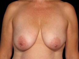 breast-lift-austin-tx