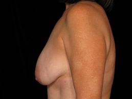 breast-lift-austin-tx